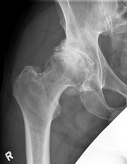Old Hip/New Life