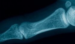 Finger x-ray
